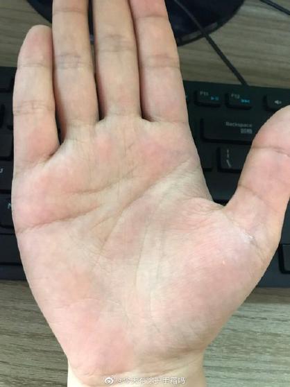 感情線斷開上下兩條