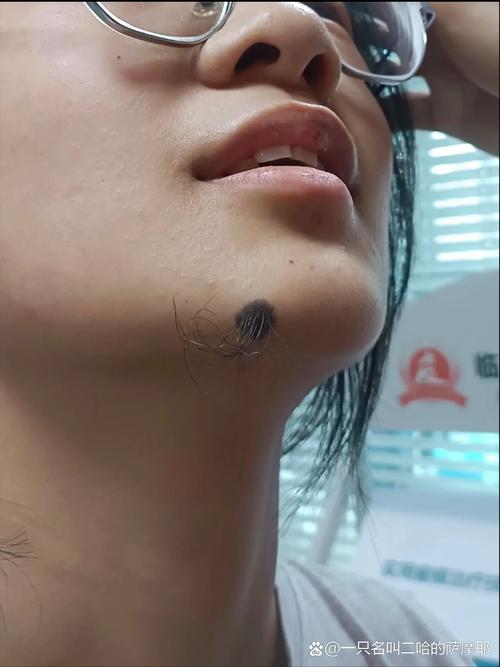 女生痣上長(zhǎng)毛好不好