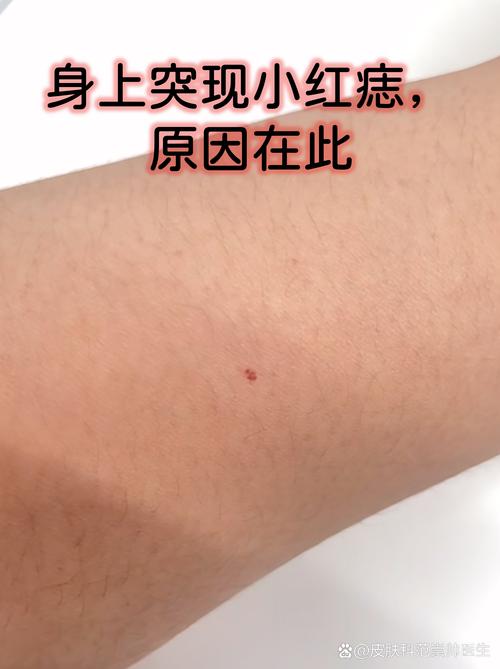 朱砂痣的傳說