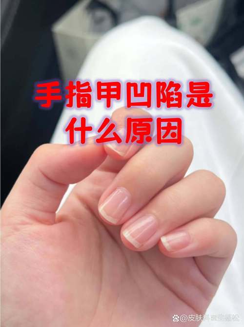指甲凹變是提醒你注意運(yùn)勢了