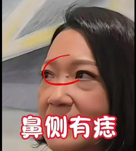 山根有痣需要點(diǎn)掉嗎