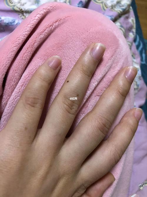 女左手無名指側面有痣