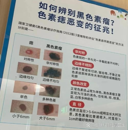 小腿肚上有痣