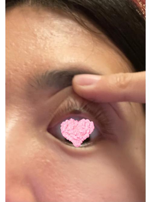 上眼瞼內有痣