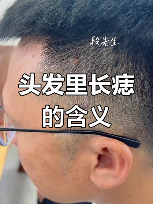 頭發里面有痣