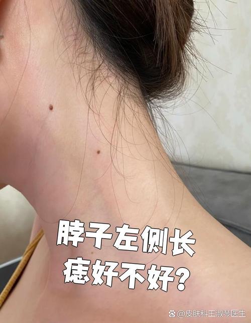 左側脖子有痣