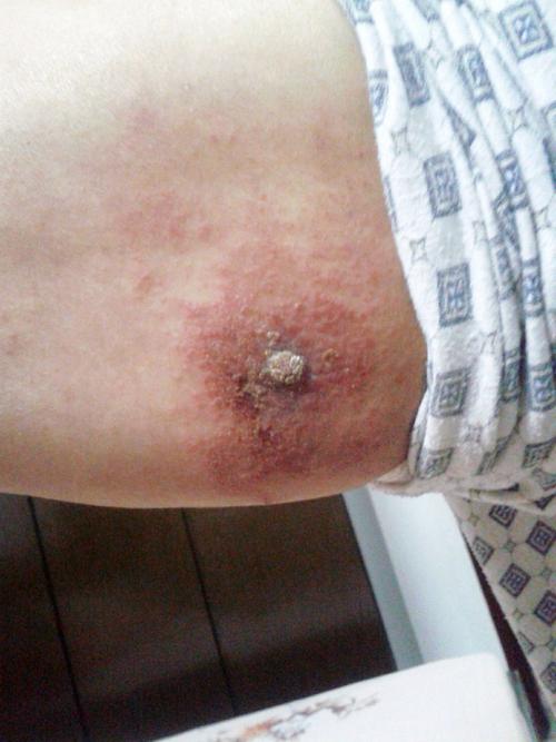 大腿后面有痣