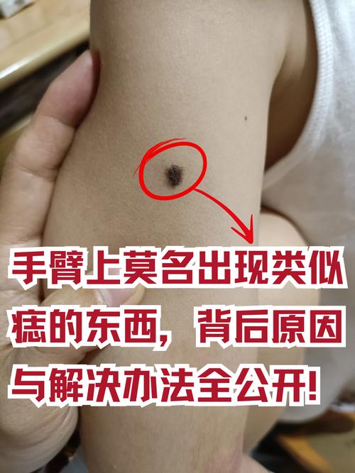 手臂中間有痣