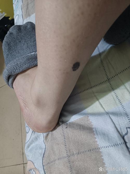小腿后面有痣