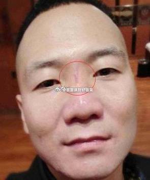 山根有疤的人好嗎 男女有什么影響
