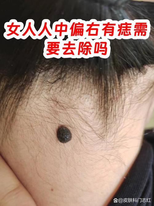 女人人中偏右有痣