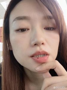 嘴皮上長痣