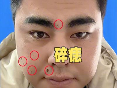 什么是狐貍痣