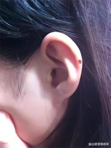 耳朵上面長痣