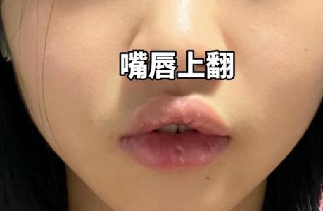 上嘴唇翹面相