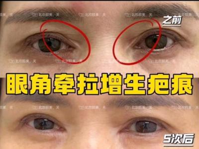 眼角有疤的人會是富貴命嗎