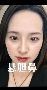 什么是懸膽鼻