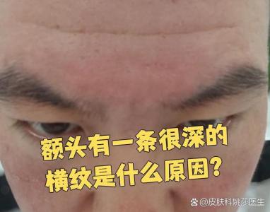 額頭上有一條橫紋